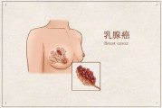 乳腺癌如何筛查招辨别乳腺癌