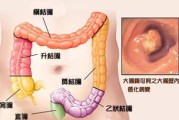 直肠癌中晚期化疗几个疗程好？如何能减轻副作用